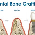 Bone Grafting: From £600-£1,000 per area