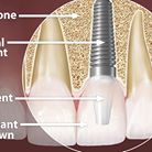 Dental Implants: From £1,900 per implant