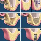 Sinus Grafting: From £1,500