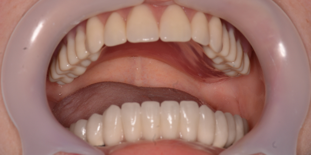 dental implants result