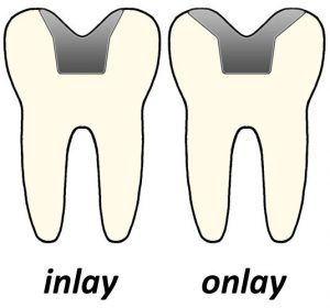 inlay and onlay