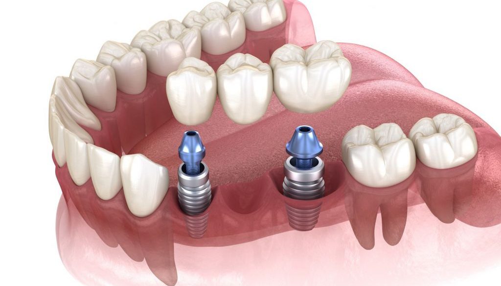 dental implant bridge