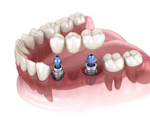 dental implant bridge