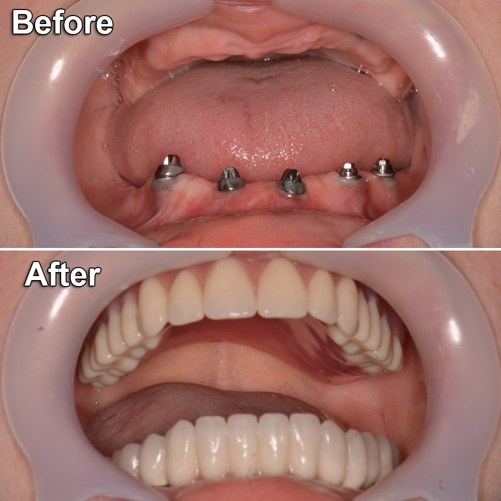 dental implants