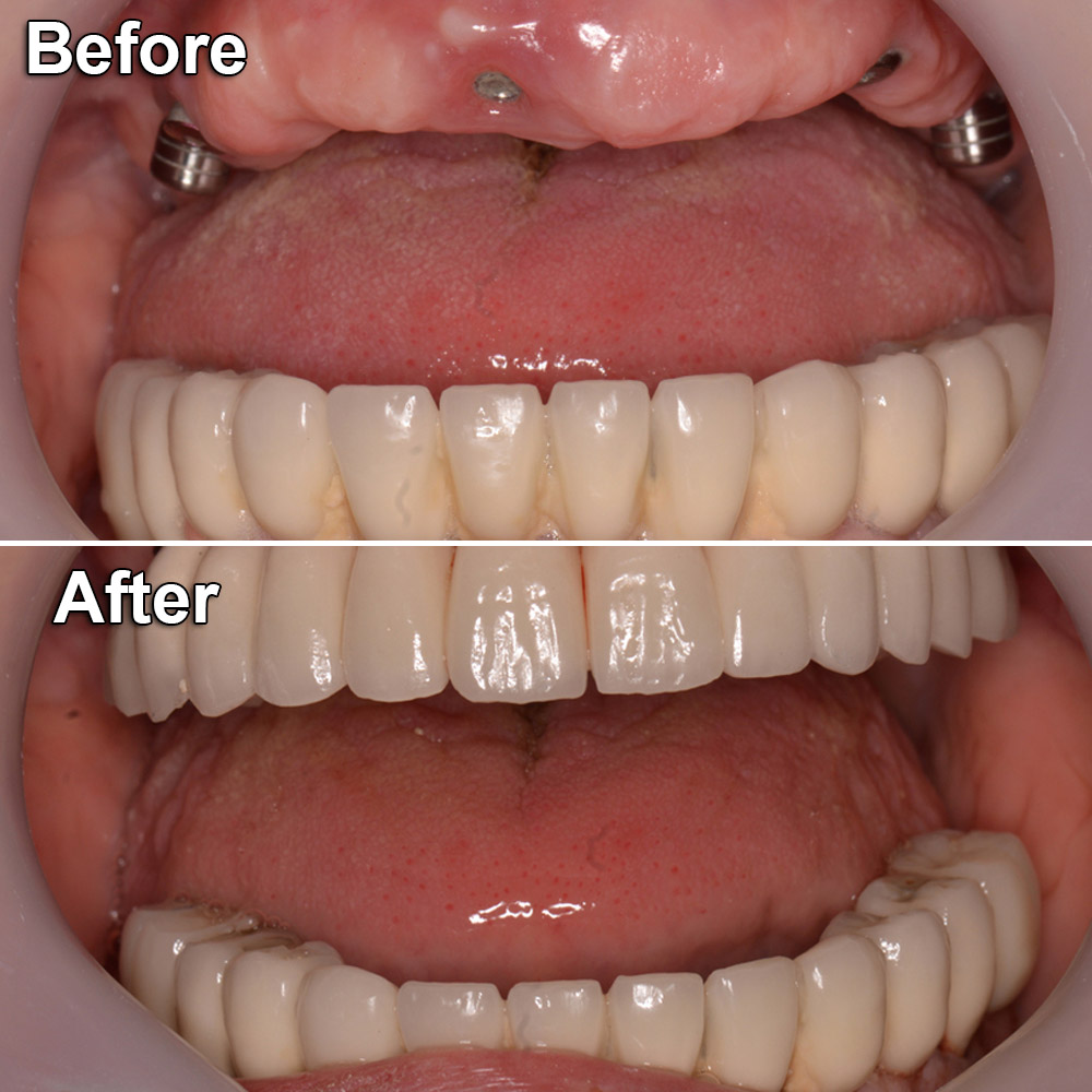 dental implants