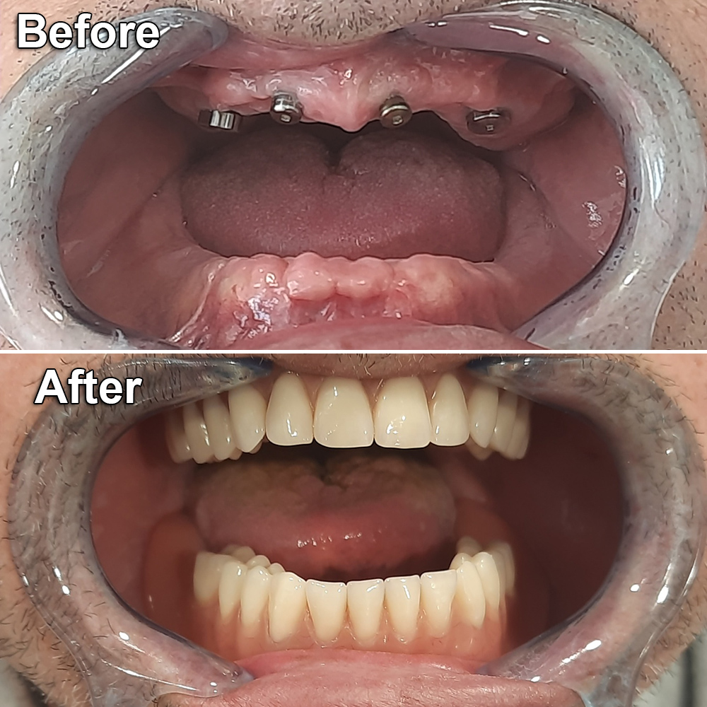 before after mouth restoration