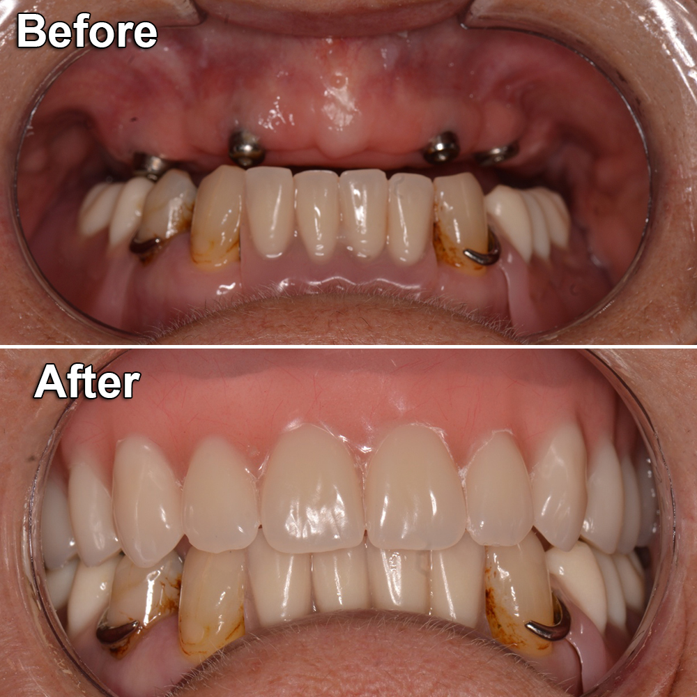 before after mouth restoration