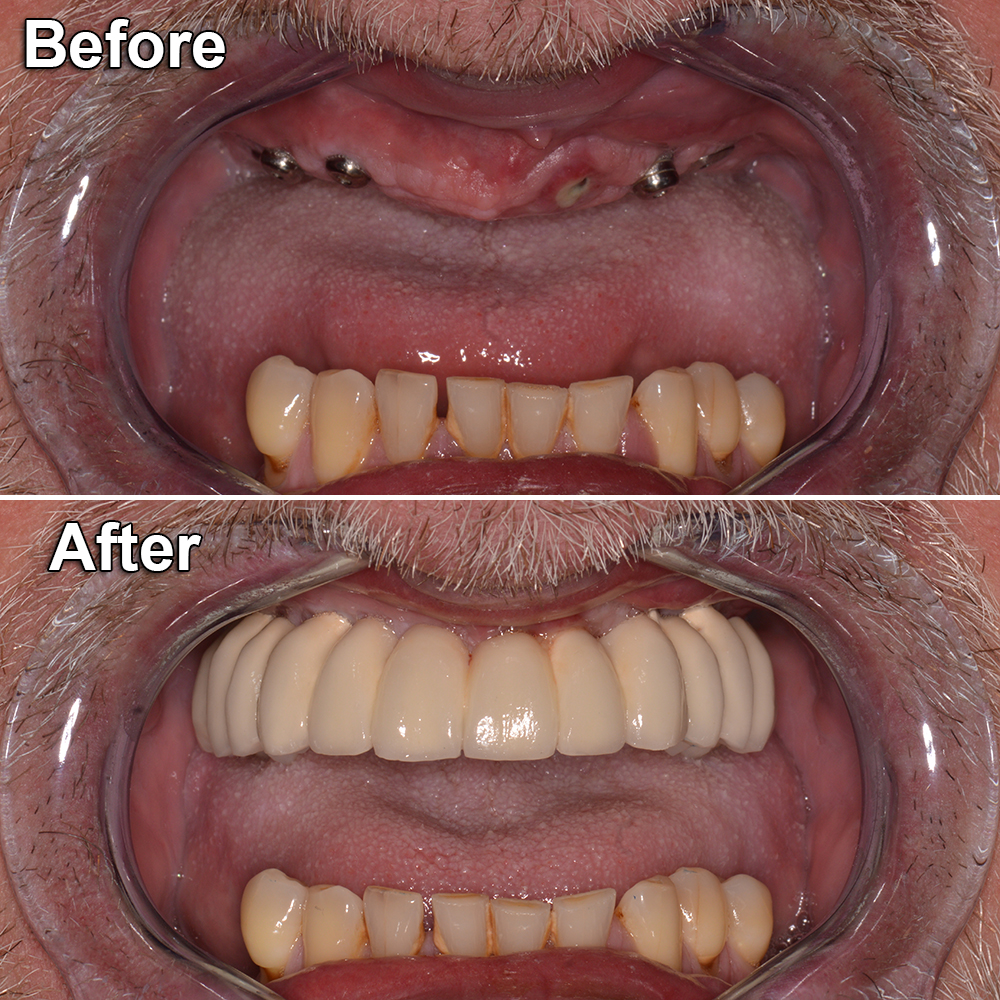 before after mouth restoration