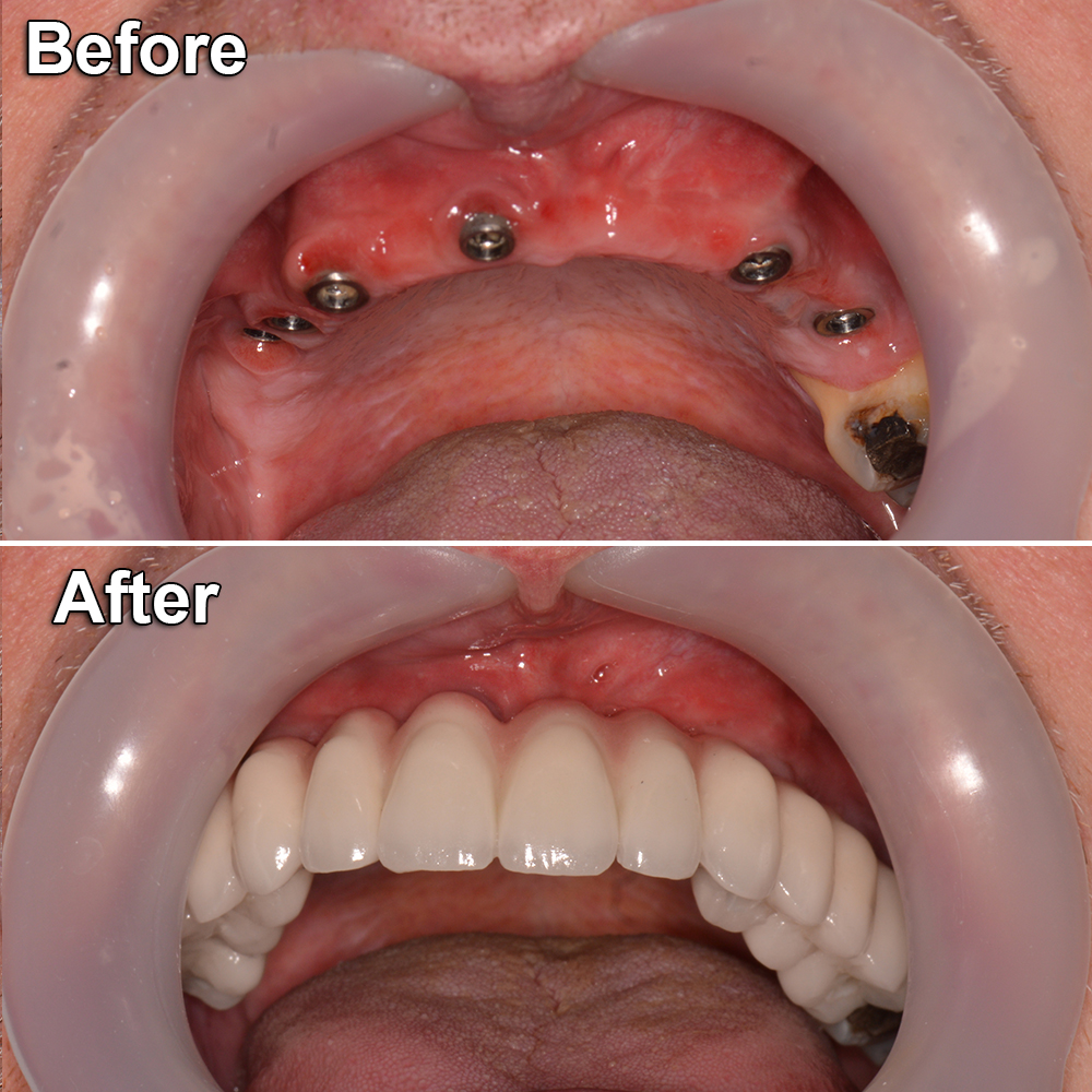 before after mouth restoration