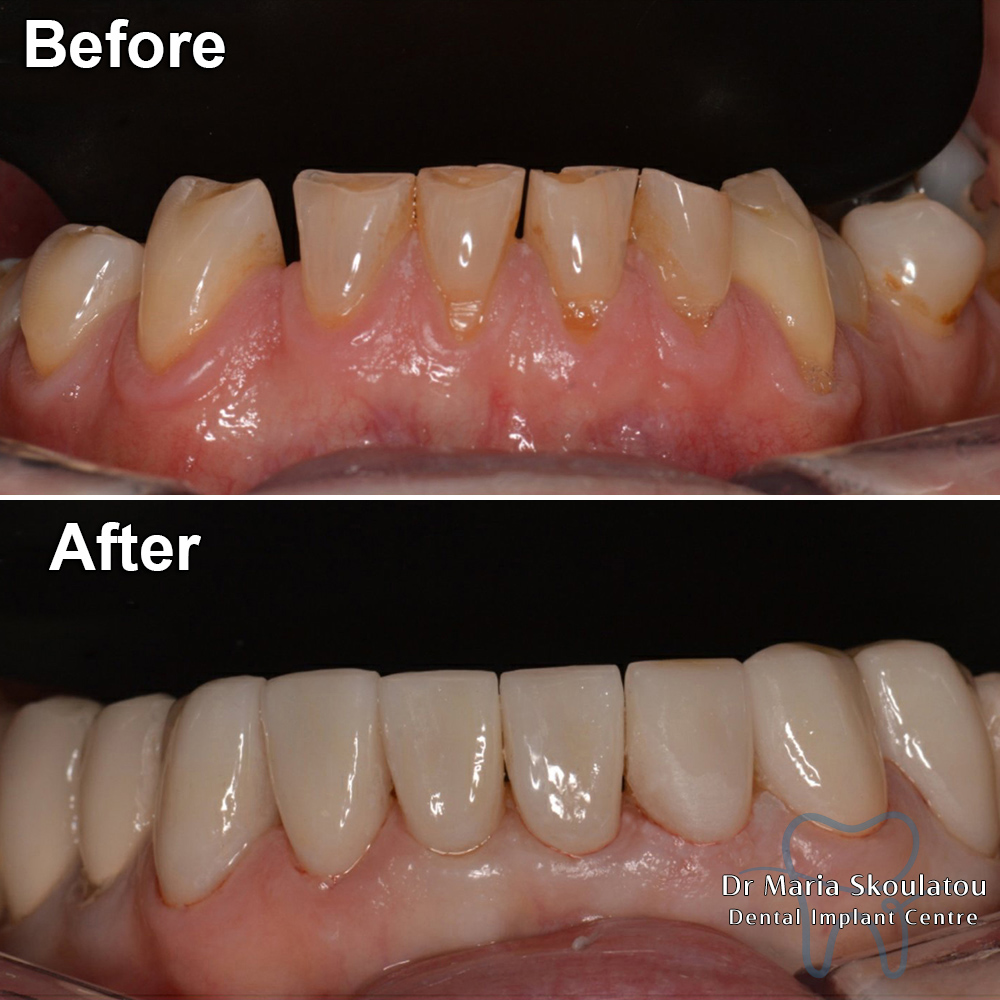 Porcelain Veneers Result by Dr Maria Skoulatou