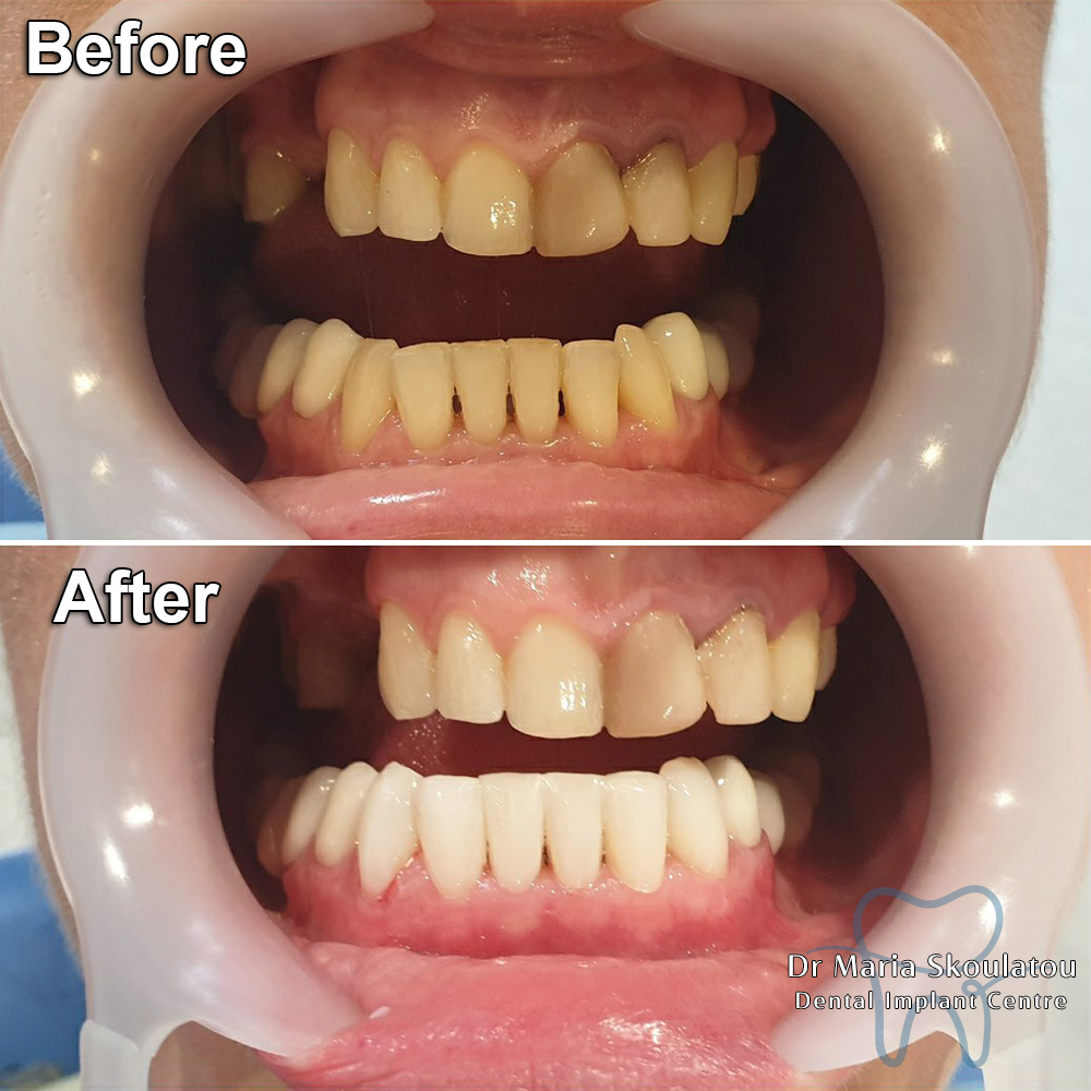 Dental Bonding Result by Dr Maria Skoulatou