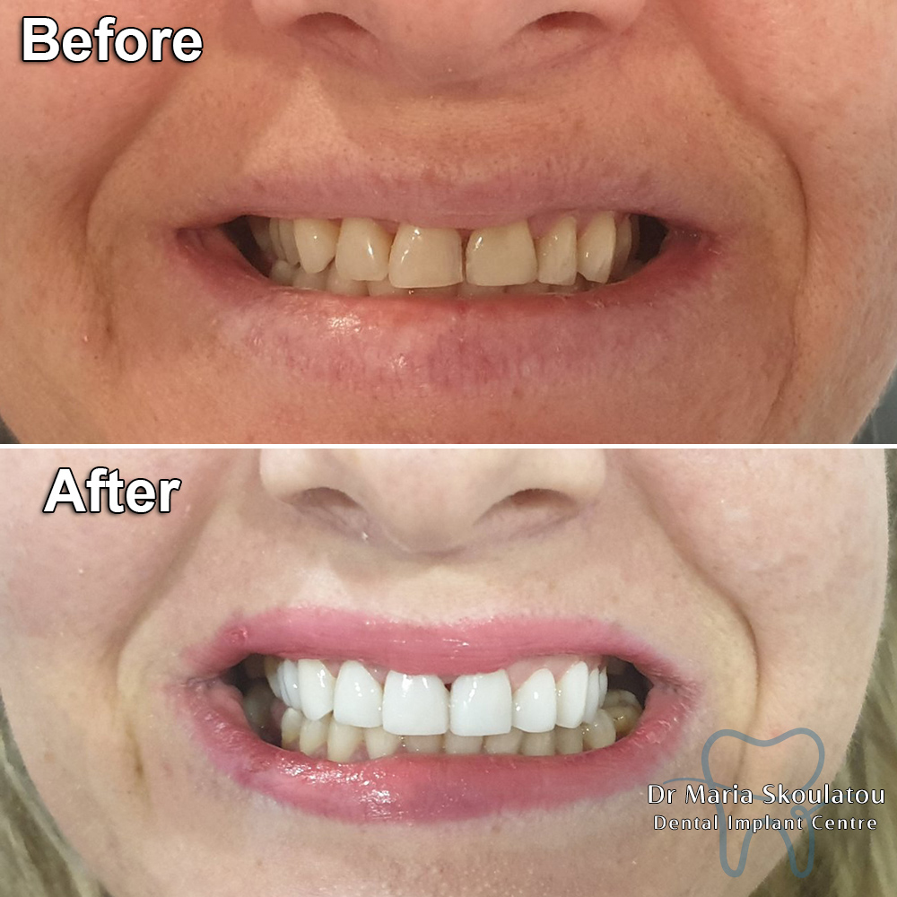 Dental Bonding Result by Dr Maria Skoulatou