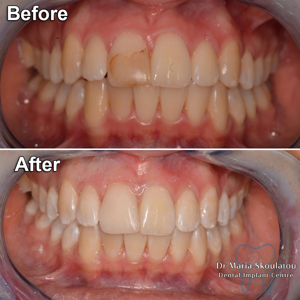 Dental Bonding Result by Dr Maria Skoulatou