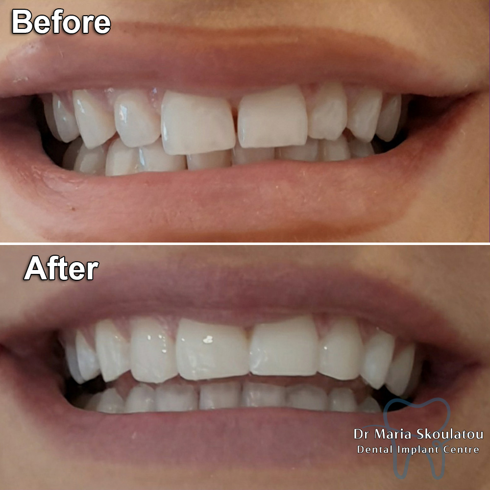 Dental Bonding Result by Dr Maria Skoulatou