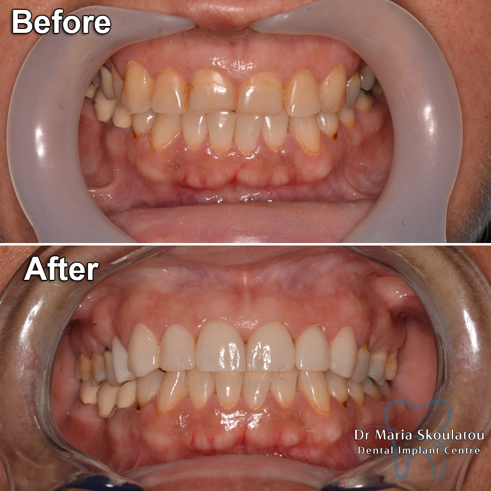 Porcelain Veneers Result by Dr Maria Skoulatou