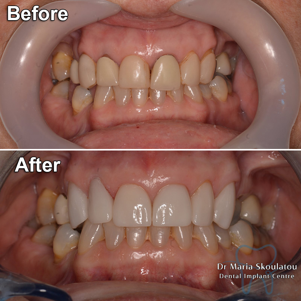 Porcelain Veneers Result by Dr Maria Skoulatou