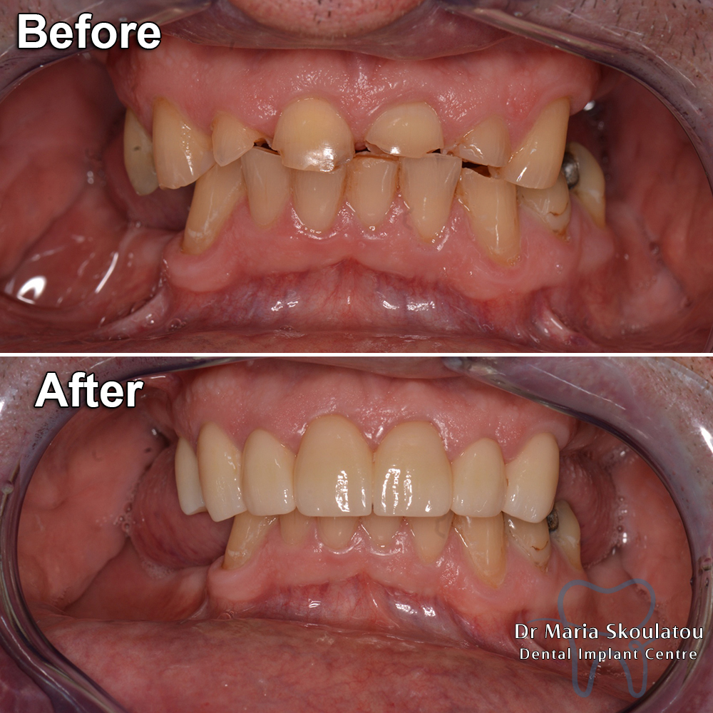 Porcelain Veneers Result by Dr Maria Skoulatou