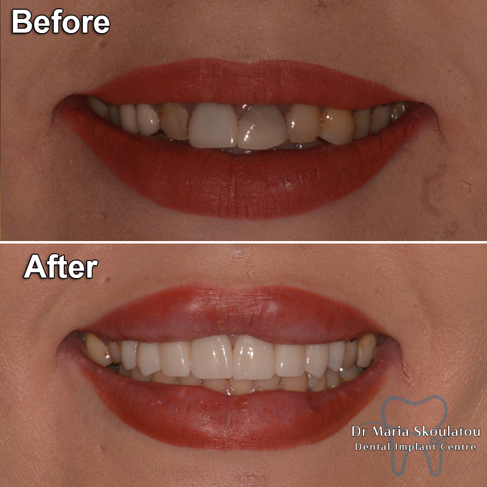 Porcelain Veneers Result by Dr Maria Skoulatou