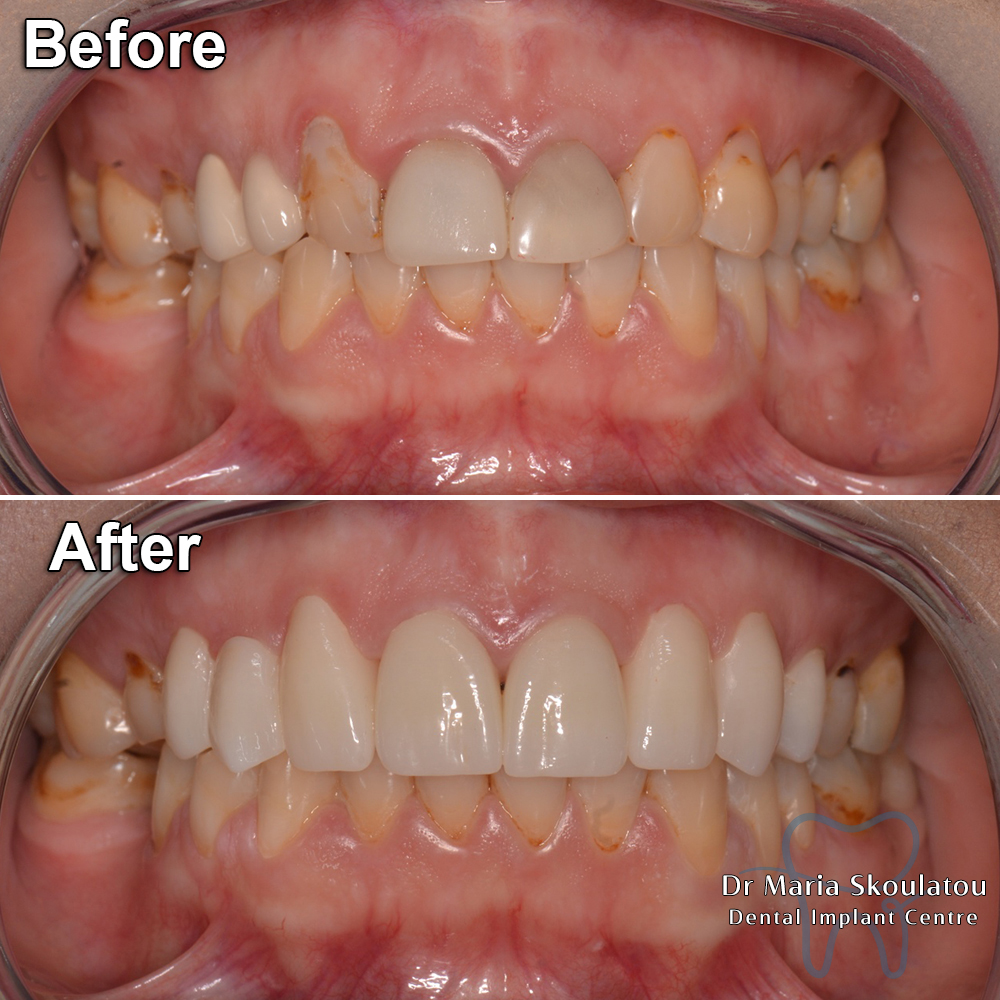 Porcelain Veneers Result by Dr Maria Skoulatou