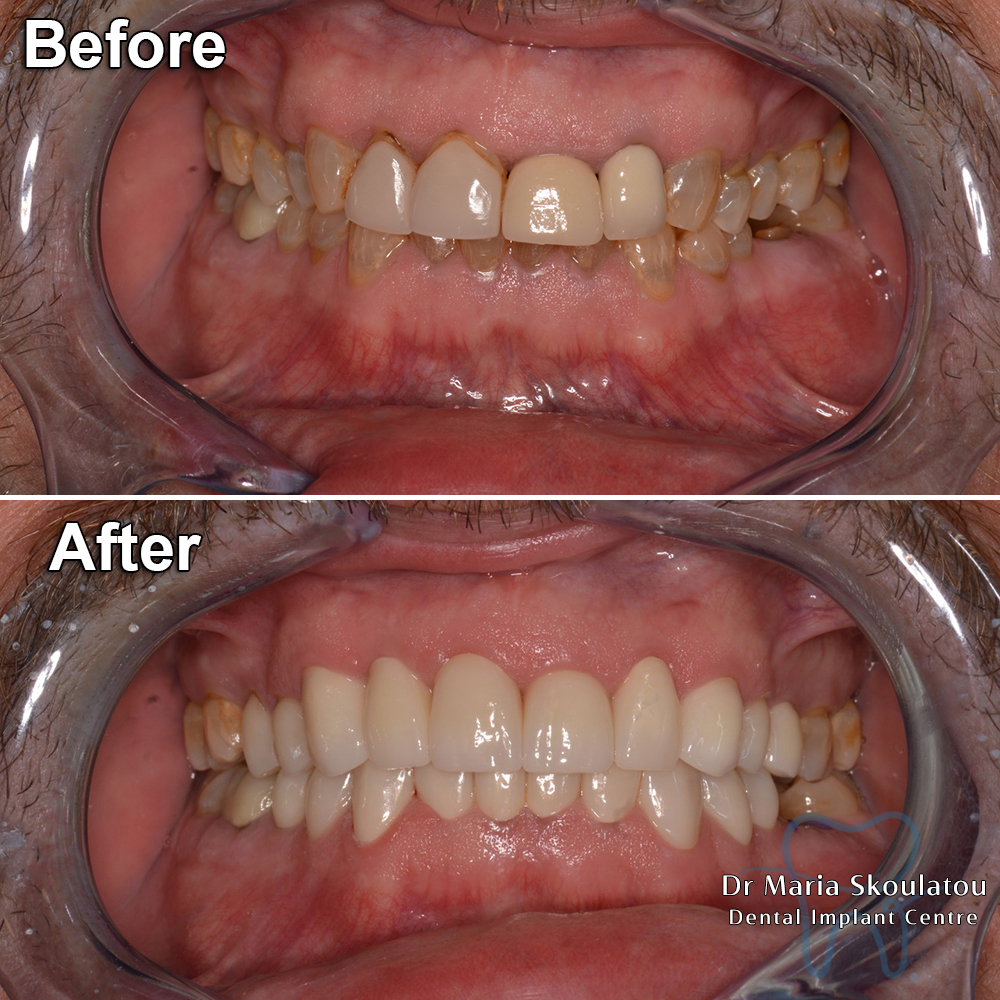 Porcelain Veneers Result by Dr Maria Skoulatou