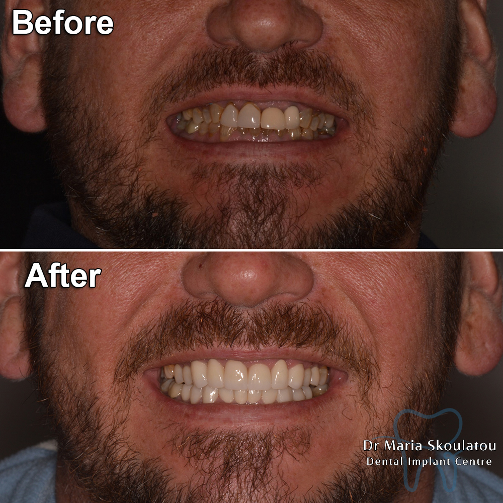 Porcelain Veneers Result by Dr Maria Skoulatou