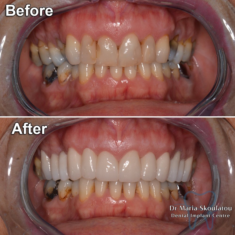 result29beforeafter-veneers