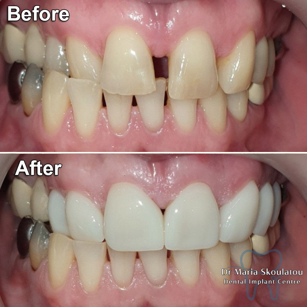 Porcelain Veneers Result by Dr Maria Skoulatou