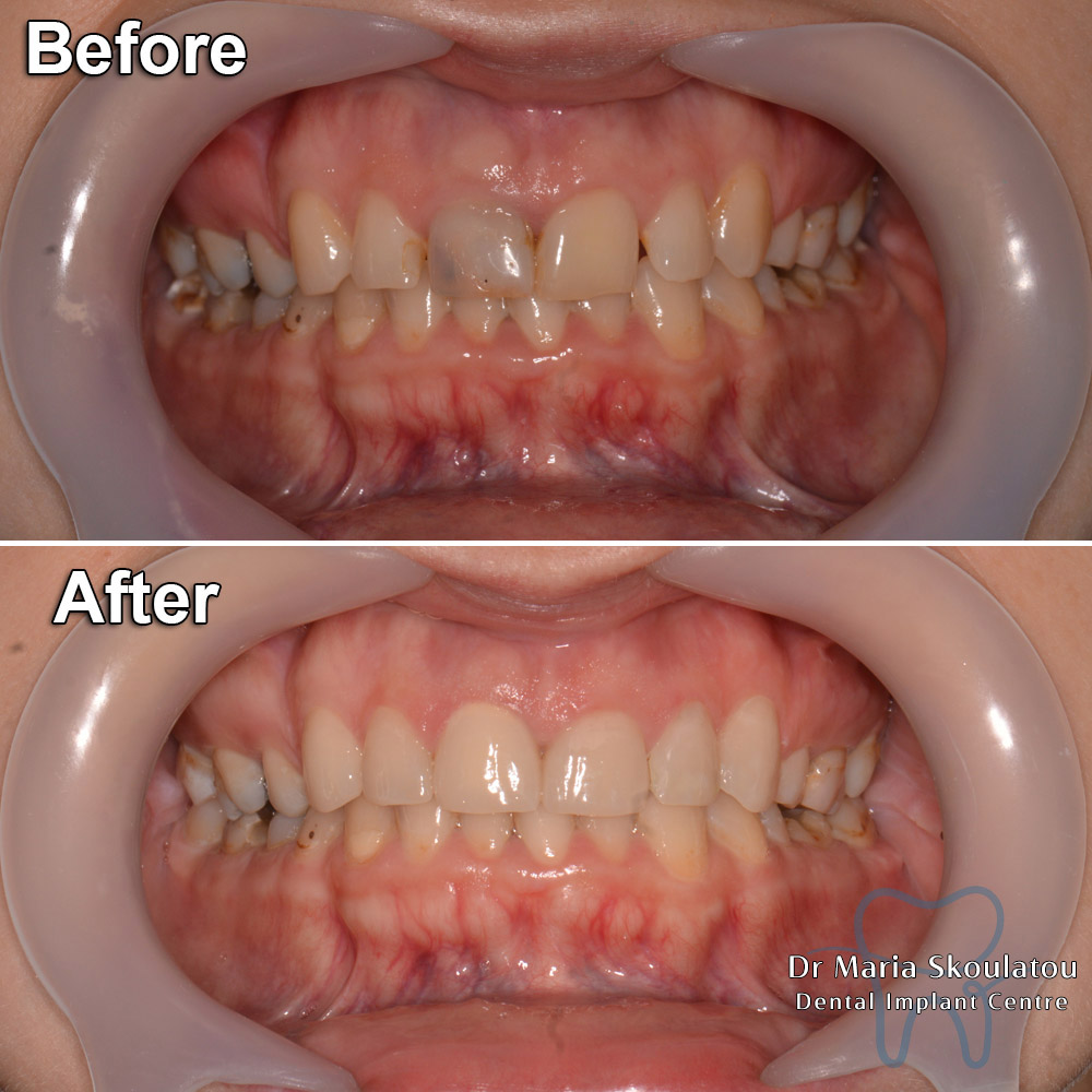 Porcelain Veneers Result by Dr Maria Skoulatou