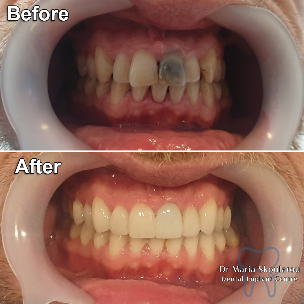 Porcelain Veneers Result by Dr Maria Skoulatou