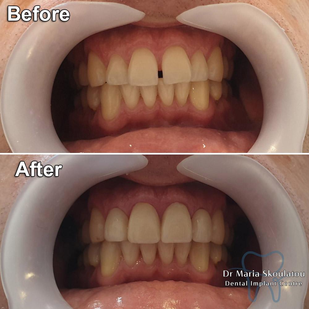 Porcelain Veneers Result by Dr Maria Skoulatou