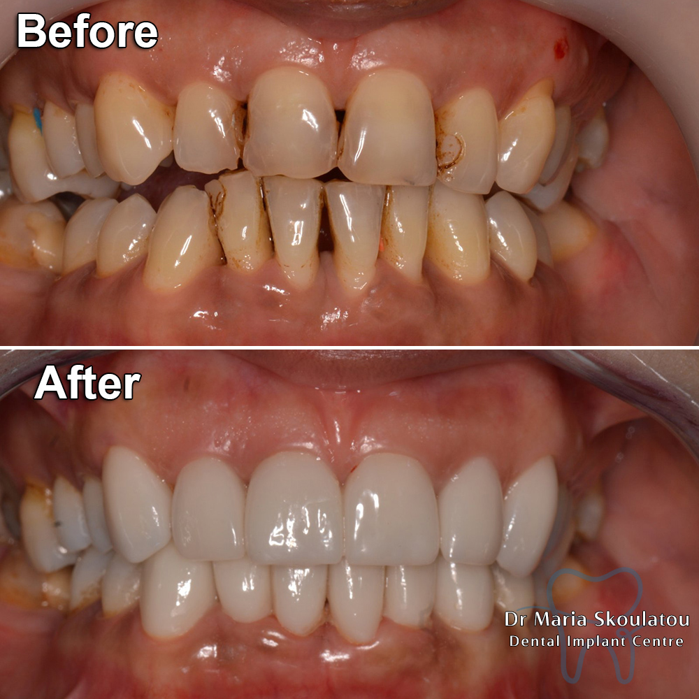 Porcelain Veneers Result by Dr Maria Skoulatou