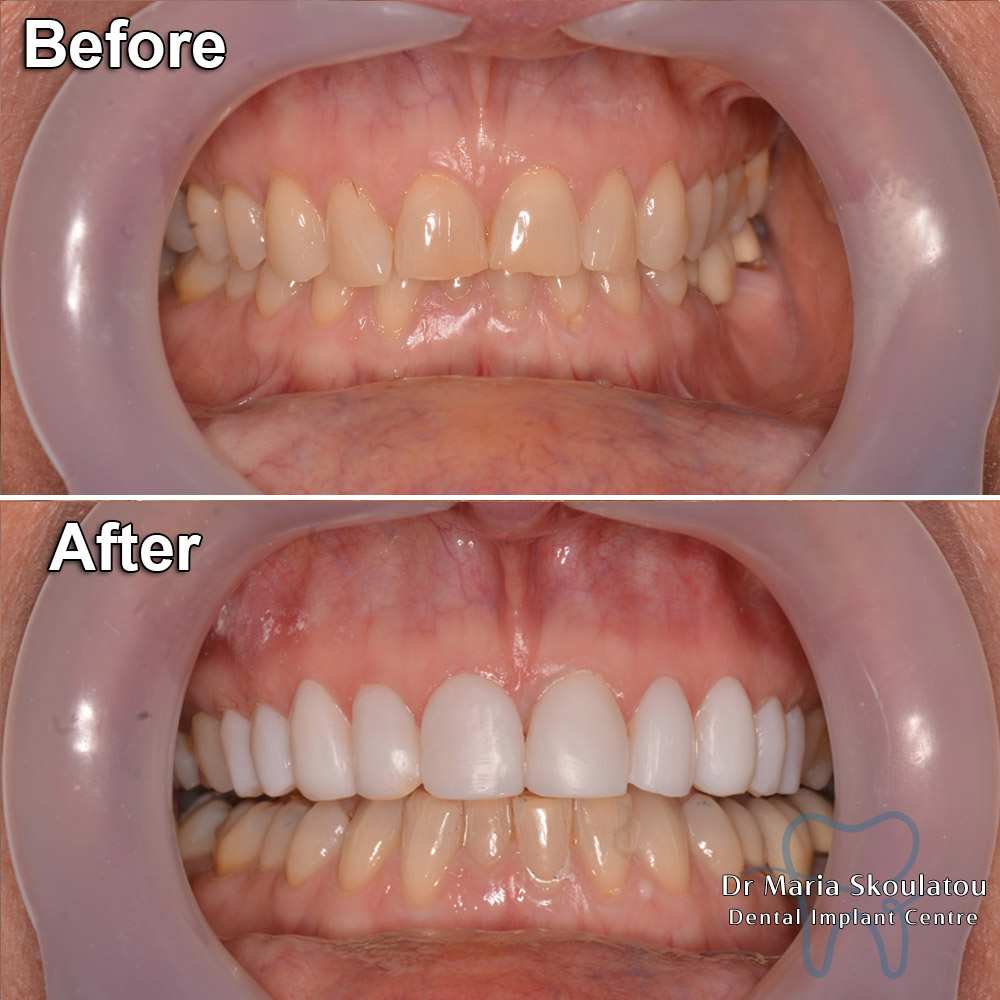 Dental Bonding Result by Dr Maria Skoulatou