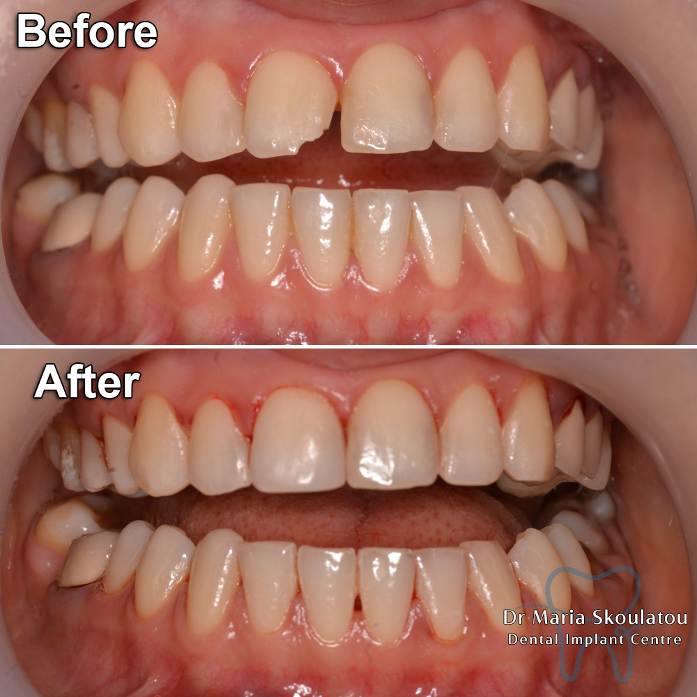 Dental Bonding Result by Dr Maria Skoulatou